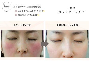 ルミエ 恵比寿店(Lumie)/LDM水玉リフティングで肌管理