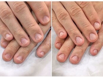 リファーレ(RIFARE)/【深爪矯正】当日の変化