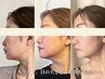 【小顔】頬の変化を実感！筋トレ&艶肌小顔リフトアップ　¥16500→¥8800