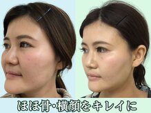 ナチュラルパーフェクトフェイス 新宿/頬、顎、フェイスラインのお肉