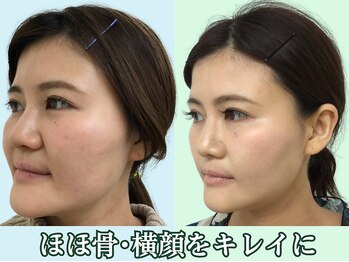 ナチュラルパーフェクトフェイス 新宿/頬、顎、フェイスラインのお肉