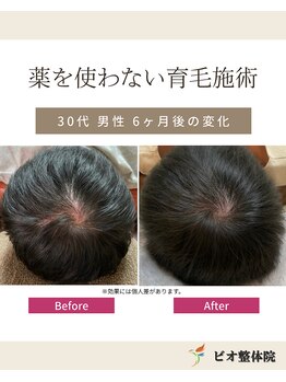 ビオ整体院 北 名古屋院/再生育毛促進術