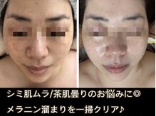 アルページュ(Arpege)の雰囲気（秋の韓流ブライト♪宝石ピール付も大好評！お肌質から改善★）