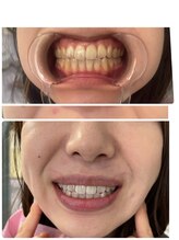 らくらく韓国エステ/セルフホワイトニング