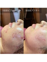 マリー(Mary.)/ハーブピーリング＆ホームケア