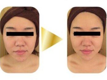 シュシュ 恵比寿店(Chou chou)/小顔/リフトアップ/ほうれい線