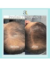 アリアンド(ari.and)/プロセル育毛促進　症例写真