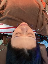 ハリファ鍼灸院 横浜関内院(HariFa鍼灸院)/美容鍼/美容鍼