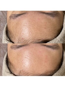 リラチル(relachill)/顔脱毛