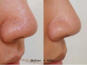 ヴィサージュ 下通店/毛穴・ざらつき/毛穴洗浄・引締