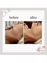 クイーン(QUEEN)/LDM水玉リフトビフォーアフター