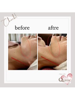 クイーン(QUEEN)/LDM水玉リフトビフォーアフター