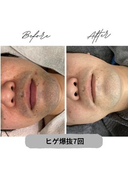 プレジール 大野城店(plaisir)/ヒゲ脱毛