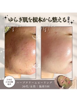 薫風の写真/ハーブピーリング日本1位のプロ在籍のサロン★剥離DTなし！仕上げはグロッティでエクソソーム高速導入！