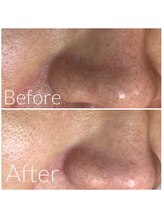 ウエカ(ueka)/医師監修毛穴エクストラクション