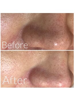 ウエカ(ueka)/医師監修毛穴エクストラクション