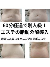 スキャニング@ラボエステ/最新導入マシンで脂肪撃退！