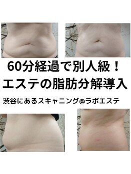 スキャニング@ラボエステ/最新導入マシンで脂肪撃退!