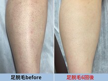 ミスターアンクール 鹿児島(Mr.uncoeur)/ひざ下脱毛6回後