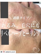 アトリエリン 小牧本店(Atelier Rin)/たるみ毛穴