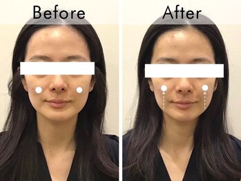 ハリラウンジ 梅田店(Hari Lounge)/美容鍼専門サロン Hari Lounge