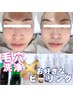 ＜大好評＞毛穴洗浄＋お好きなピーリング 80分～ 15,000円