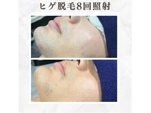 ボゴス 天白店(BOGOSS)/【ヒゲ脱毛】施術写真