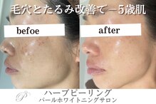 パールホワイトニング