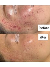 ビー ブルーム(B BLOOM)/【ニキビケア】繰り返さない肌へ