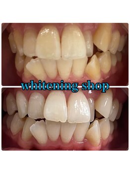 ホワイトニングショップ 越谷店/