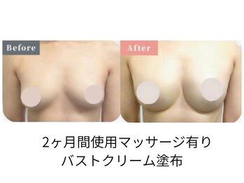 リルマコ/バスト症例写真