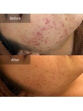 ビビ(VIVI)/ストレスでできたニキビ改善も◎