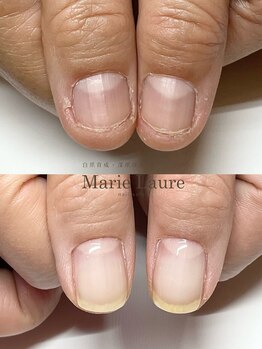 マリーロール 梅田店(Marie Laure)/自爪育成/深爪矯正/ネイルケア
