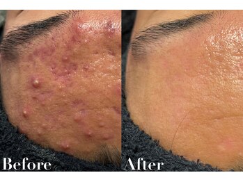 ビジュー(美柔 Bijou)/REVI剥離有・無ハーブピーリング