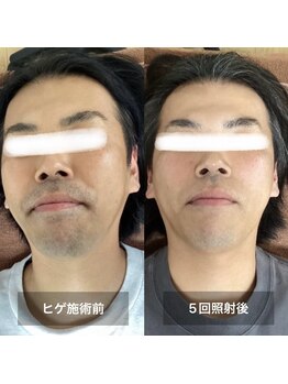 リリー(RILY)/【ビフォーアフター】