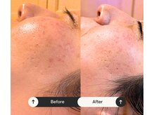 ゆう/顔のむくみが引いてる！