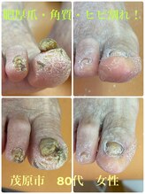 巻き爪じゅん 千葉駅前店/お正月に肥厚爪・角質・ヒビ割れ