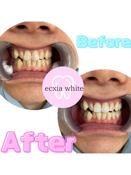 エクシアホワイトニング 新白河店/ホワイトニングビフォーアフター