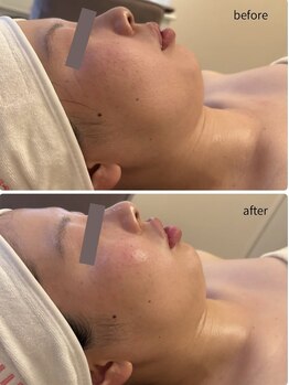 リミュール(Ri.miyuru)/小顔ケアで艶肌とトーンアップも