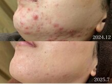 繰り返すニキビケアもお任せください♪