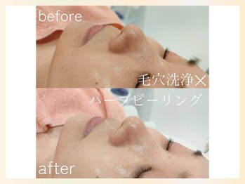 ソウナ(SONA)/厳選国産ハーブピーリング