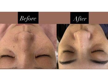 アゼリア 本厚木店(AZALEA)/【施術症例】毛穴洗浄×顔脱毛