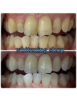 ホワイトニングショップ 池田店/【BEFORE/AFTER】