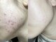 ルゥ(lou)の写真/幹細胞培養上清液導入で美肌育成！お肌のターンオーバーを整えて美肌の土台作り！くすみ・乾燥肌のケアも◎