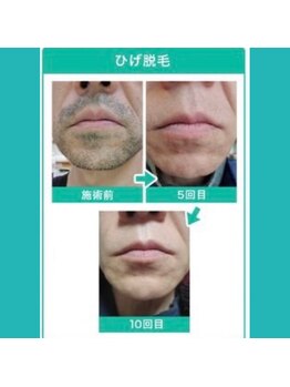 メンズ シンバ(SIMBA)/【Before→After】