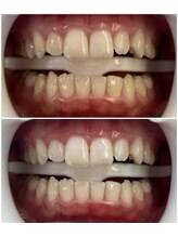 リトリート(Retreat)/ホワイトニング