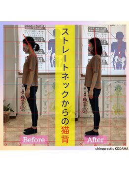カイロプラクティック コダマ(KODAMA)/ストレートネック施術