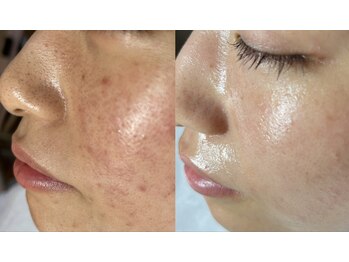 スパークル/毛穴/肌荒れ/顔脱毛/ワックス