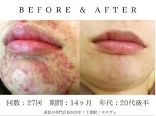 ロエヴェ(ROEWE)/ニキビ改善・毛穴ケア・肌質改善