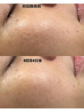 アットウィル 志木店(at will)/☆マイクロニードルピーリング☆